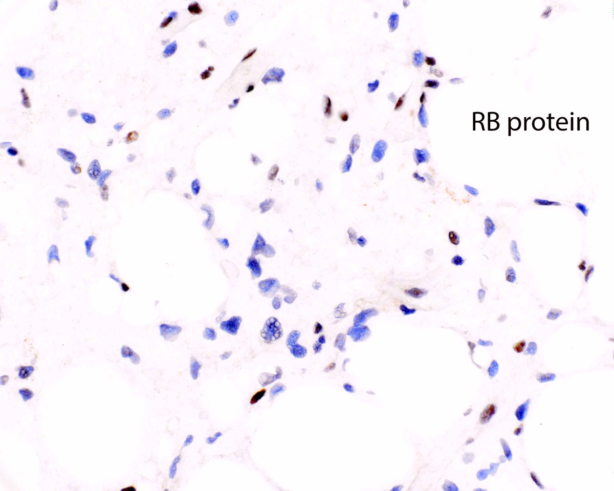 Atypical spindle cell/pleomorphic lipomatous tumor occasionally persists locally following incomplete excision, but malignant behavior has not been reported. MDM2 is not altered and RB protein is lost.  Like spindle cell and pleomorphic lipoma, it expresses CD34.