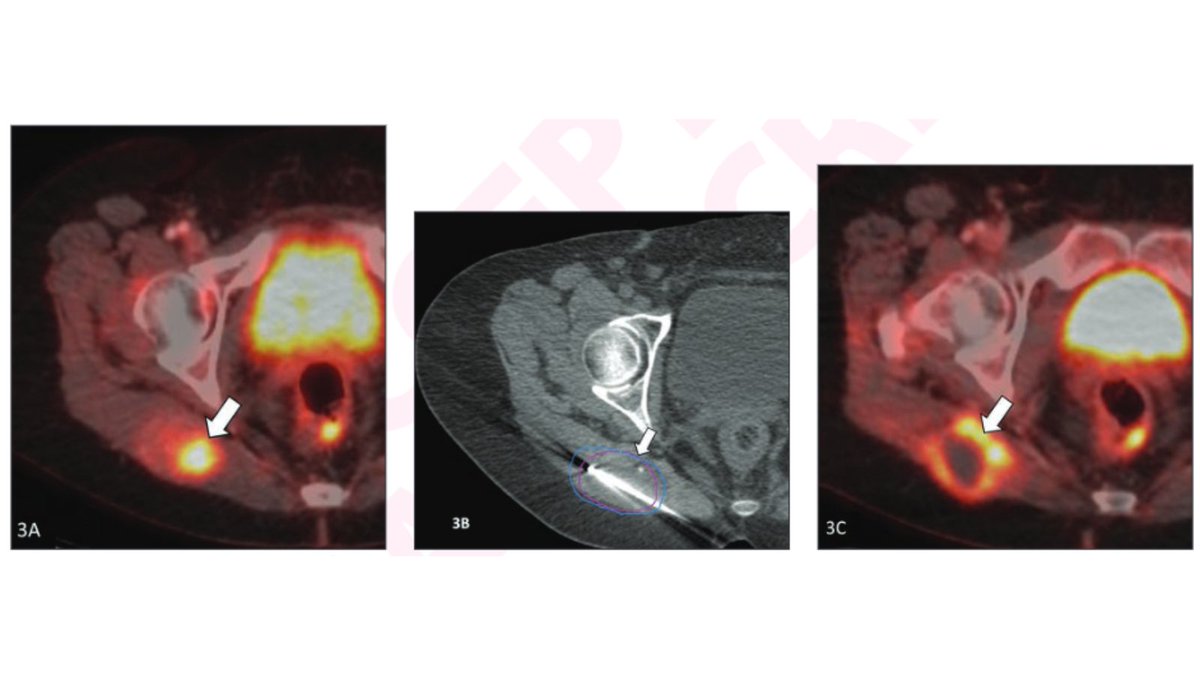 Andrew Rosenkrantz (@arosenkrantzmd) on Twitter photo New <a href="/AJR_Radiology/">AJR</a> Accepted Manuscript:
"Safety and Efficacy of Percutaneous Cryoablation for Recurrent or Metastatic Soft Tissue Sarcoma in Adult Patients"
By Drs Pal, <a href="/rahulshethmd/">Rahul Sheth</a>, & team <a href="/MDAndersonNews/">MD Anderson Cancer Center</a>
ajronline.org/doi/10.2214/AJ… New <a href="/AJR_Radiology/">AJR</a> Accepted Manuscript:
"Safety and Efficacy of Percutaneous Cryoablation for Recurrent or Metastatic Soft Tissue Sarcoma in Adult Patients"
By Drs Pal, <a href="/rahulshethmd/">Rahul Sheth</a>, & team <a href="/MDAndersonNews/">MD Anderson Cancer Center</a>
ajronline.org/doi/10.2214/AJ…