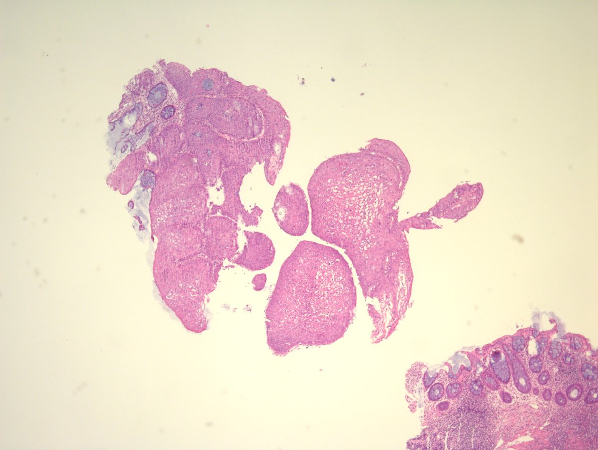 MirunaPopescu13's tweet image. Anorectal mucosa. It cannot get more textbook-like than this! 🔬
Curious to see what #PathTwitter thinks first.
Your diagnosis?

#GIPath #pathresidents