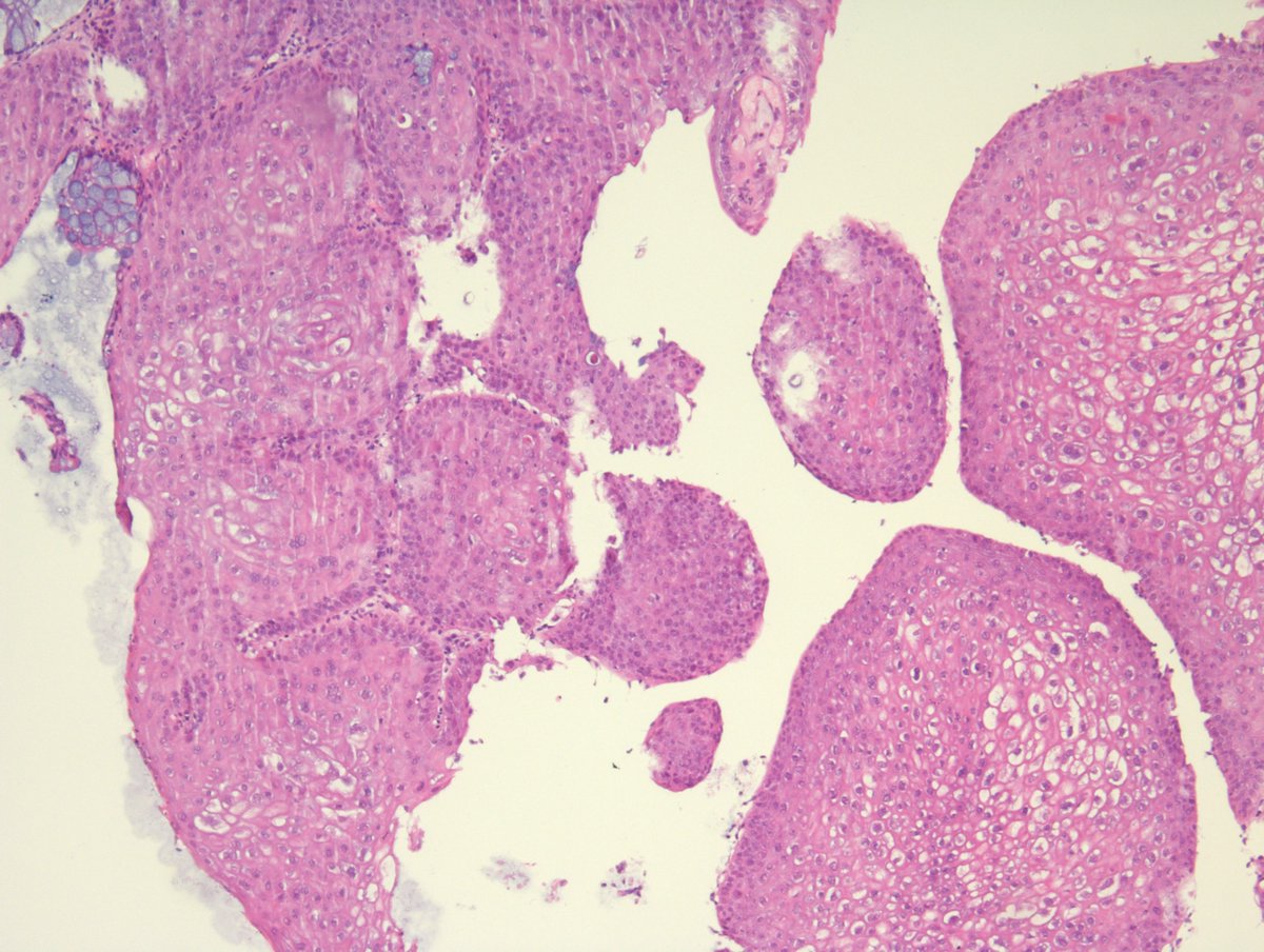 MirunaPopescu13's tweet image. Anorectal mucosa. It cannot get more textbook-like than this! 🔬
Curious to see what #PathTwitter thinks first.
Your diagnosis?

#GIPath #pathresidents