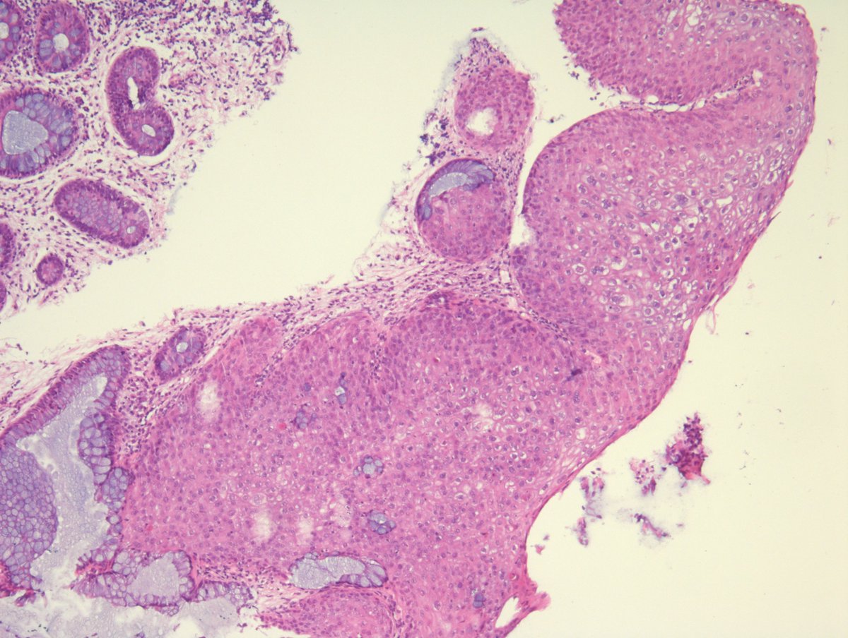 MirunaPopescu13's tweet image. Anorectal mucosa. It cannot get more textbook-like than this! 🔬
Curious to see what #PathTwitter thinks first.
Your diagnosis?

#GIPath #pathresidents