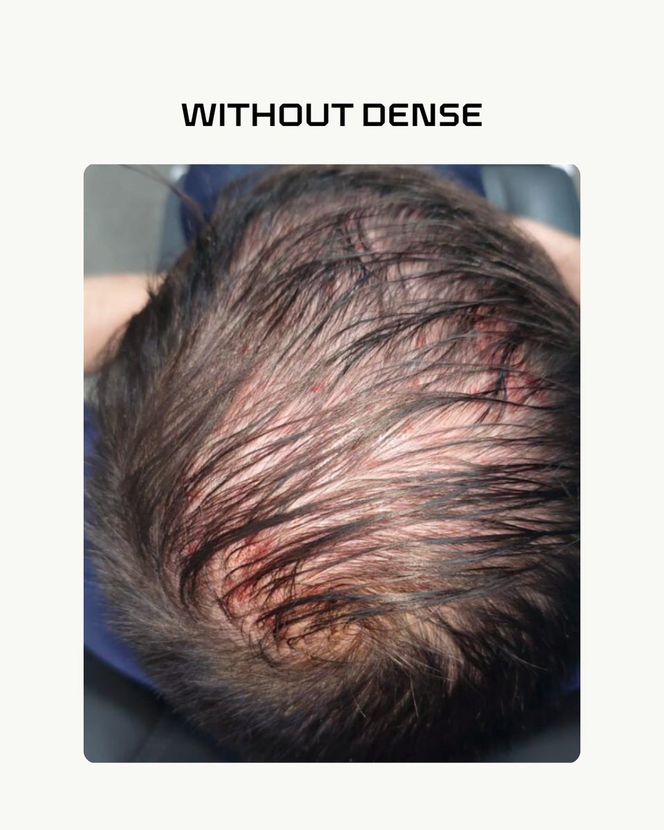 Dense Hair Experts tweet media