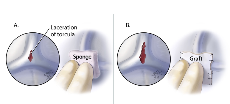 neurosurgatlas's tweet photo. The first step in an injury to the torcula is to tamponade the injury with a piece of Gelfoam and cottonoid patty for small lacerations, or suture a piece of fascia or allograft dura for larger lacerations. How should more extensive lacerations be repaired? #MedTwitter https://t.co/Npbejper3A