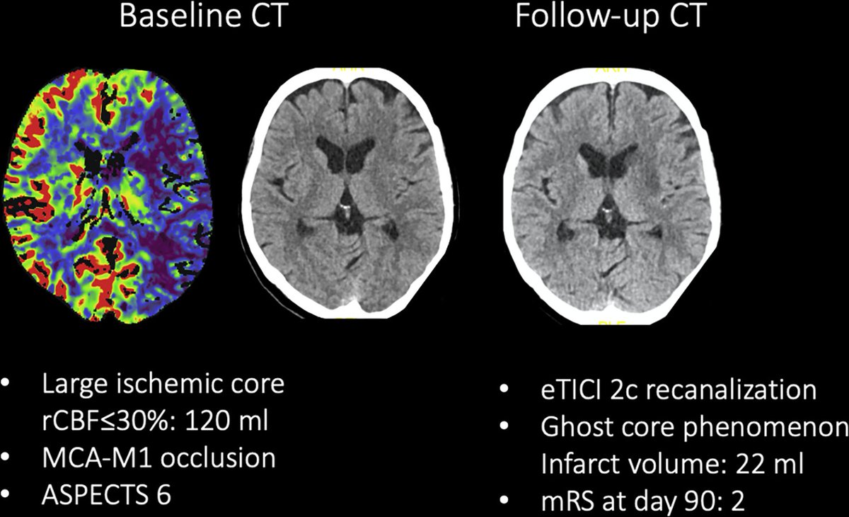 Radiology (@radiology_rsna) on Twitter photo Overestimation of the ischemic core is associated with higher core lesion volume and degree of reperfusion after thrombectomy. bit.ly/4caYXoW <a href="/BroocksGabriel/">Gabriel Broocks</a> <a href="/AndreKemmling/">André Kemmling</a> <a href="/Fie0815/">Jens Fiehler</a> <a href="/JeremyHeitMDPHD/">Jeremy Heit, MD, PhD</a> Overestimation of the ischemic core is associated with higher core lesion volume and degree of reperfusion after thrombectomy. bit.ly/4caYXoW <a href="/BroocksGabriel/">Gabriel Broocks</a> <a href="/AndreKemmling/">André Kemmling</a> <a href="/Fie0815/">Jens Fiehler</a> <a href="/JeremyHeitMDPHD/">Jeremy Heit, MD, PhD</a>