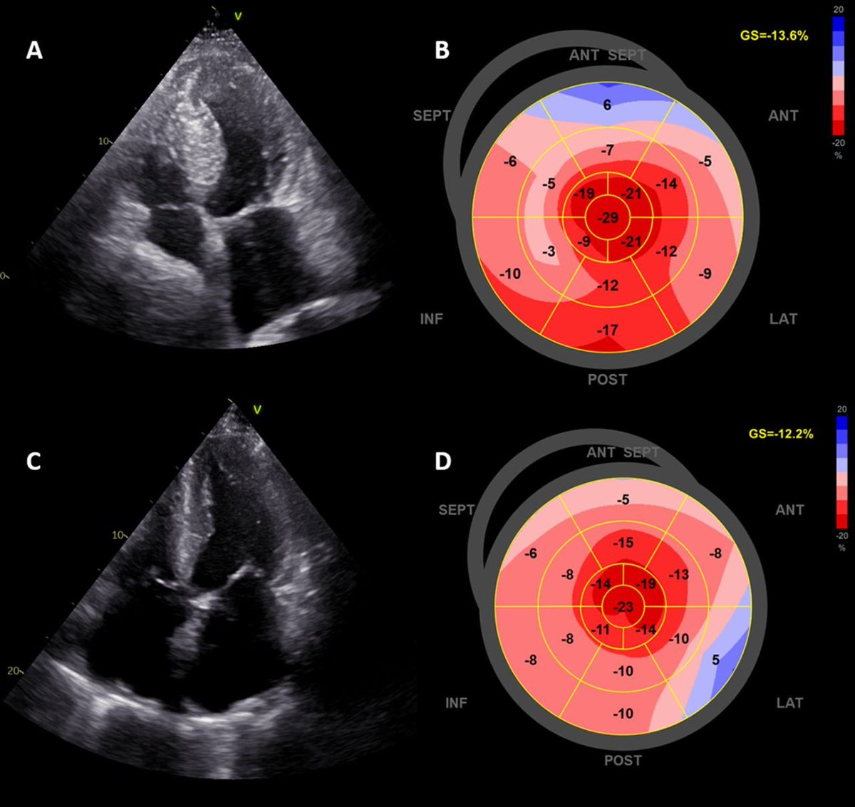 Ritika Tuli (@ritikatulimd) on Twitter photo 🫀What is this pattern of strain commonly referred to as, and what is its clinical implication? #CardioTwitter #CardioPearls #echofirst <a href="/ACCinTouch/">American College of Cardiology</a> 🫀What is this pattern of strain commonly referred to as, and what is its clinical implication? #CardioTwitter #CardioPearls #echofirst <a href="/ACCinTouch/">American College of Cardiology</a>