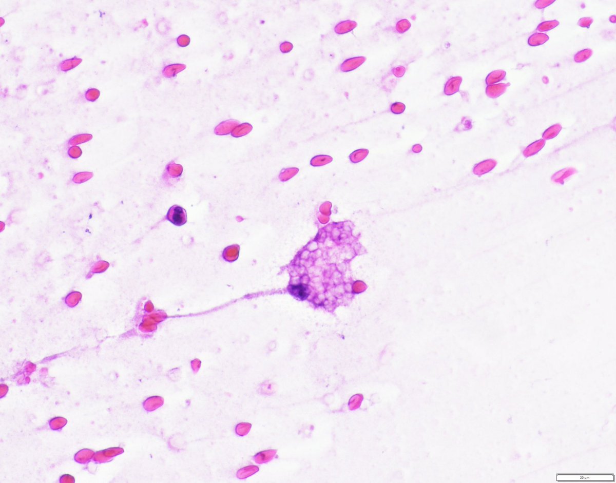 bitar_mireille's tweet image. Cerebellar brain tumor in a child, #grosspath and #cytopath, findings are classic for this #tumor

Diagnosis? Syndromic association? 

#pedipath #neuropath #molecpath #path
