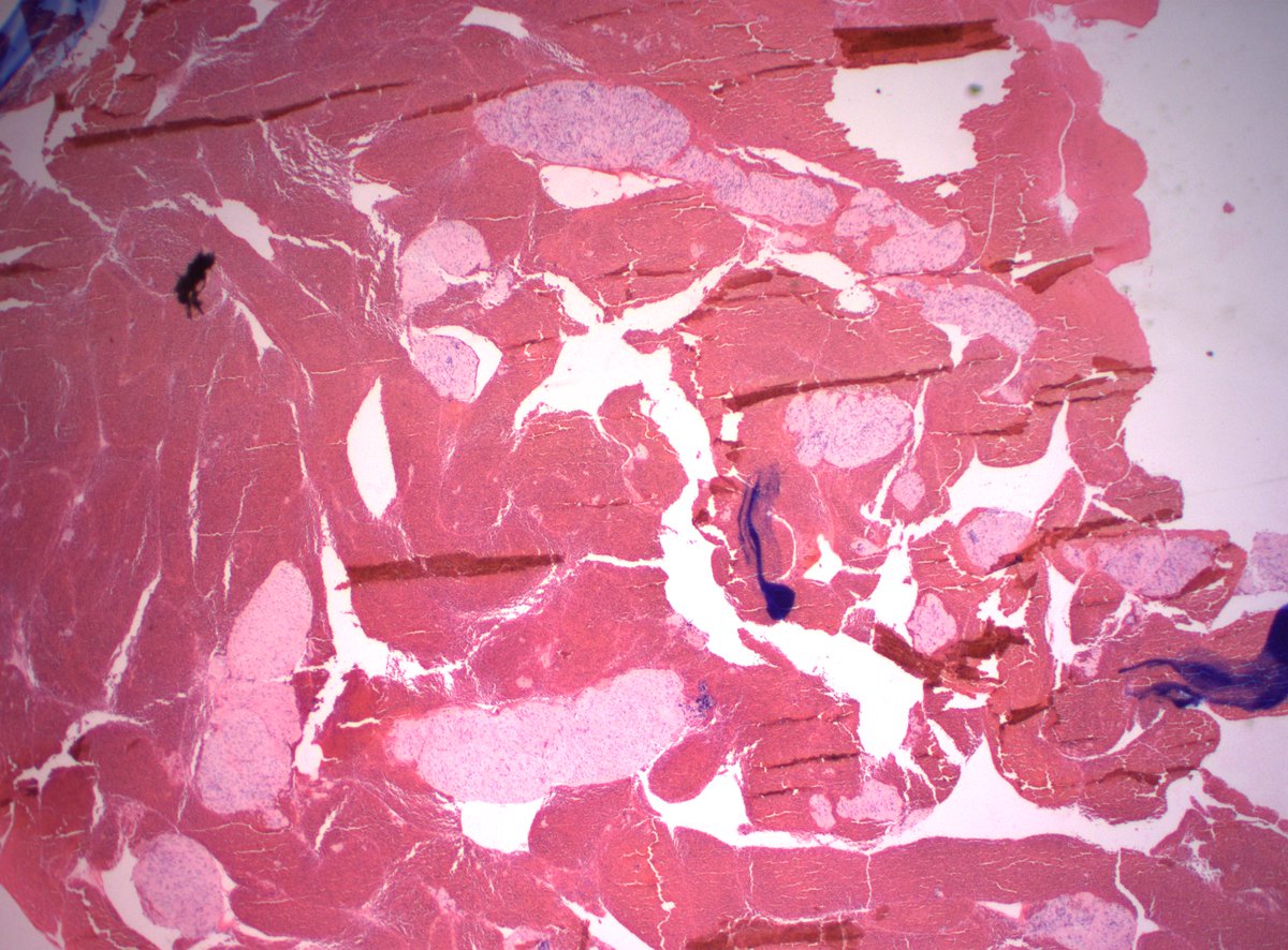 DanGrahamMD's tweet photo. 70s F 3.1cm submucosal duodenal mass. Dx? Stains?

#PathX #PathTwitter https://t.co/EhqBIR3z0X