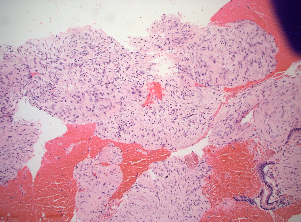 DanGrahamMD's tweet photo. 70s F 3.1cm submucosal duodenal mass. Dx? Stains?

#PathX #PathTwitter https://t.co/EhqBIR3z0X