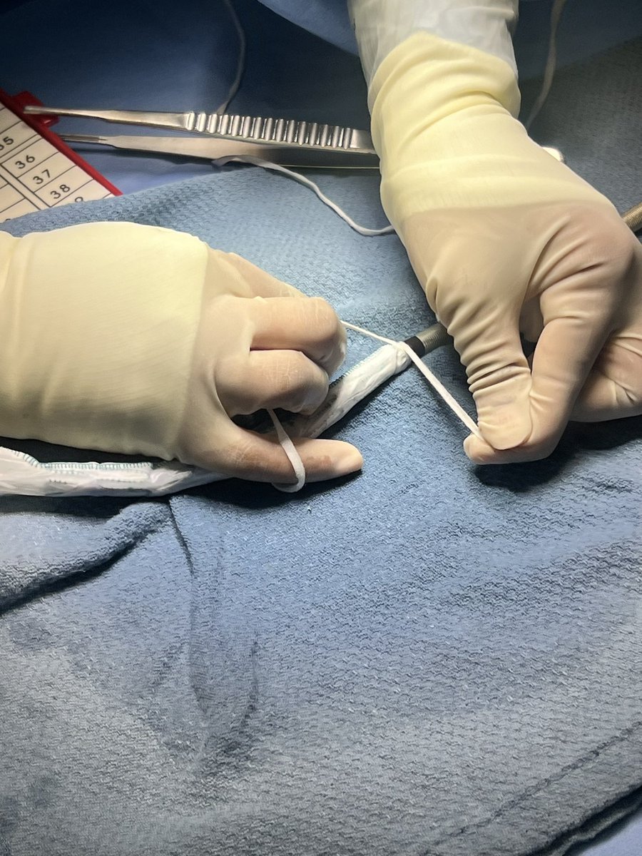 Jeromy Brink, MD (@jsbrinkmd) on Twitter photo When “on label” technology falls short, creative solutions from the back table are necessary. Other options in this high risk patient with challenging anatomy?<a href="/uazphxsurgery/">UAZ Medicine - PHX Surgery</a> <a href="/AortaEd/">AortaEd</a> <a href="/TerumoAortic/">Terumo Aortic</a> When “on label” technology falls short, creative solutions from the back table are necessary. Other options in this high risk patient with challenging anatomy?<a href="/uazphxsurgery/">UAZ Medicine - PHX Surgery</a> <a href="/AortaEd/">AortaEd</a> <a href="/TerumoAortic/">Terumo Aortic</a>