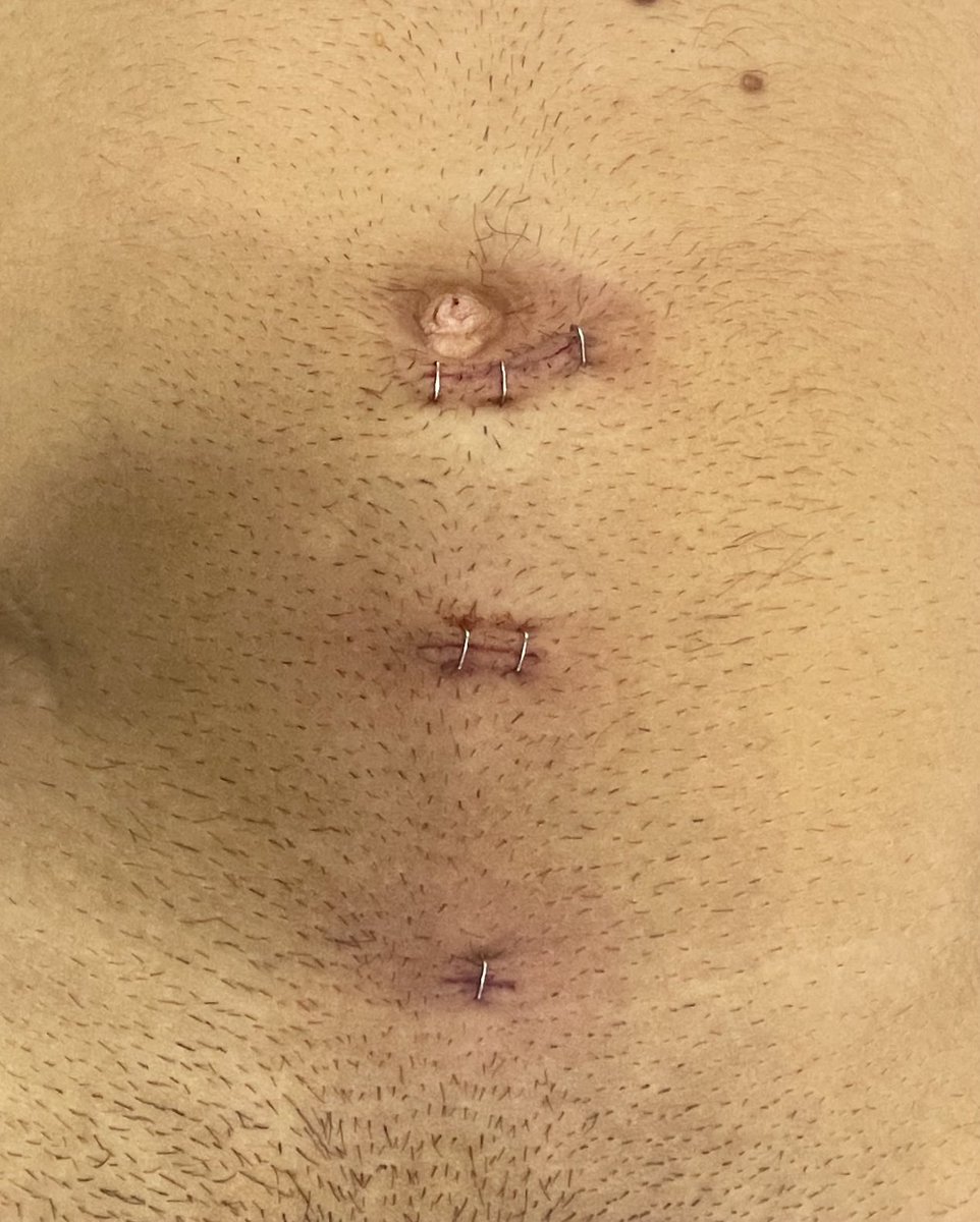 olea_mar's tweet photo. Otro jueves operando hernias inguinales bilaterales por laparoscopia, la magia del abordaje totalmente extraperitoneal. Nuestro esfuerzo por los pacientes tiene recompensa. https://t.co/DGpLlETxe7