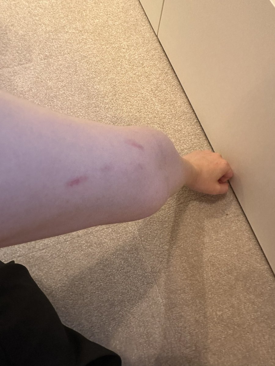 赤子、抱っこしてるとだいたい二の腕を吸ってる😂けっこう力強い！ふとみたらマークついてた笑