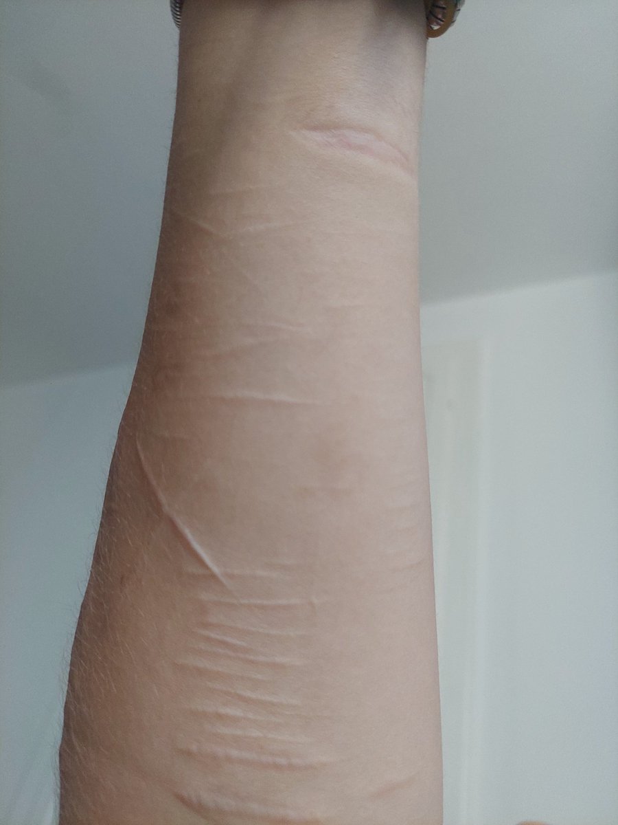 p4ssword101's tweet photo. My healed arms brooo I haven't posted in soooo long, yes I'm alive😋 https://t.co/oLOvs8TJPQ