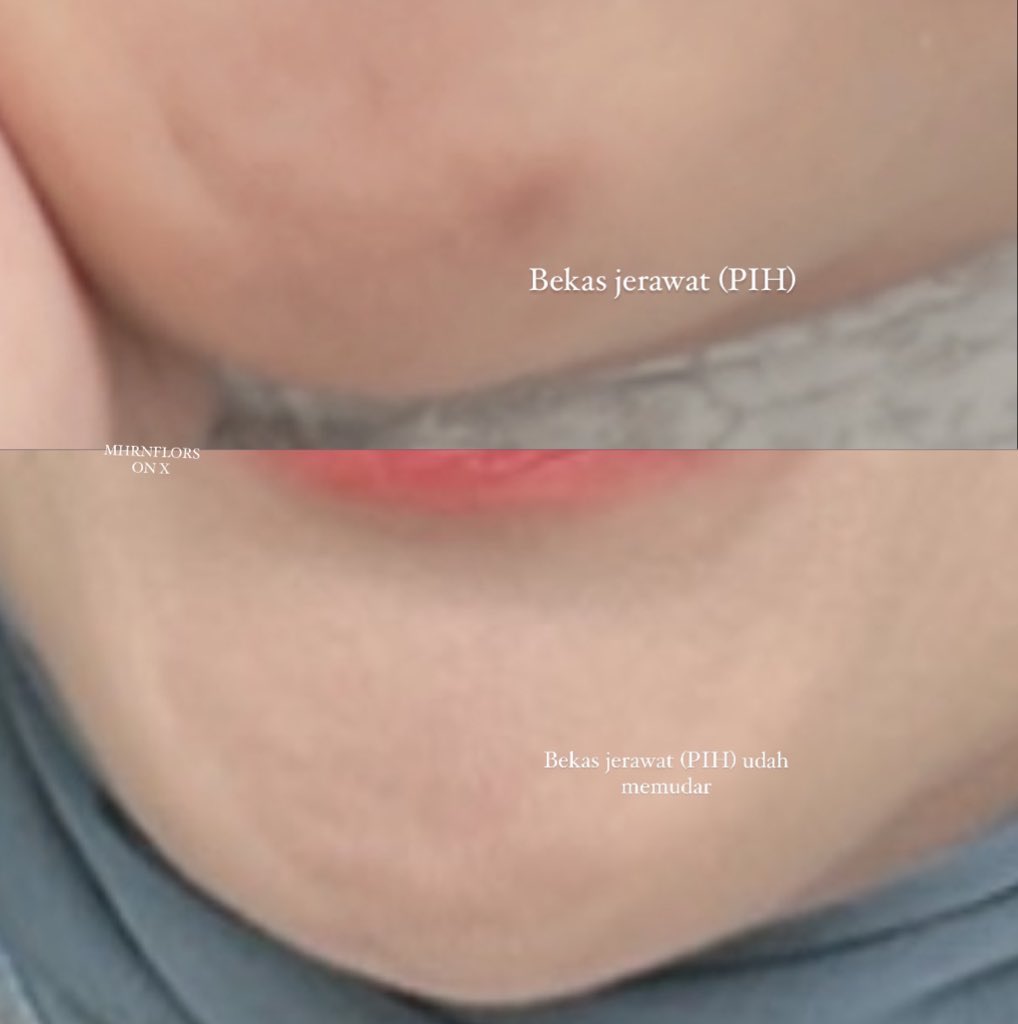 nrosynr's tweet photo. @womanfeeds_id RILL SUNGKEM BGTT SAMA SKIN1004😭🙏🏼 aku pake ampoule nya ini nampoll bgtt. Pokonya yg punya bnyak bekas jerawat + wajah kusam wajib coba ini🫵🏻

Kandungan pencerah nya lengkap bgttt, ampuh bgtt hempas bekas jerawat (PIH) ku + bikin wajah lebih cerah juga. Isinya jg bnyakk‼️ https://t.co/YFcQXzFM7r