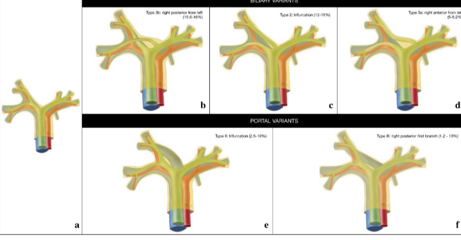 HPB unit Hospital del Mar (@hpbmar) on Twitter photo How many approaches do you know for MINIMALLY INVASIVE LEFT HEPATECTOMY?
Find out it in our recent publication and chose the best for your patient 
<a href="/CEIHPBA/">CE-IHPBA</a> <a href="/LopezBenS/">santi lopez ben</a> <a href="/ILLS_LAPLIVER/">ILLS</a> <a href="/liverunitclinic/">LiverUnit.Clinic.BCN</a> <a href="/TaigaWaka/">Taiga Wakabayashi</a> <a href="/ca_ihpba/">ca.ihpba@gmail.com</a> <a href="/AhmadAbouAbbas8/">Ahmad Abou Abbass</a> out How many approaches do you know for MINIMALLY INVASIVE LEFT HEPATECTOMY?
Find out it in our recent publication and chose the best for your patient 
<a href="/CEIHPBA/">CE-IHPBA</a> <a href="/LopezBenS/">santi lopez ben</a> <a href="/ILLS_LAPLIVER/">ILLS</a> <a href="/liverunitclinic/">LiverUnit.Clinic.BCN</a> <a href="/TaigaWaka/">Taiga Wakabayashi</a> <a href="/ca_ihpba/">ca.ihpba@gmail.com</a> <a href="/AhmadAbouAbbas8/">Ahmad Abou Abbass</a> out