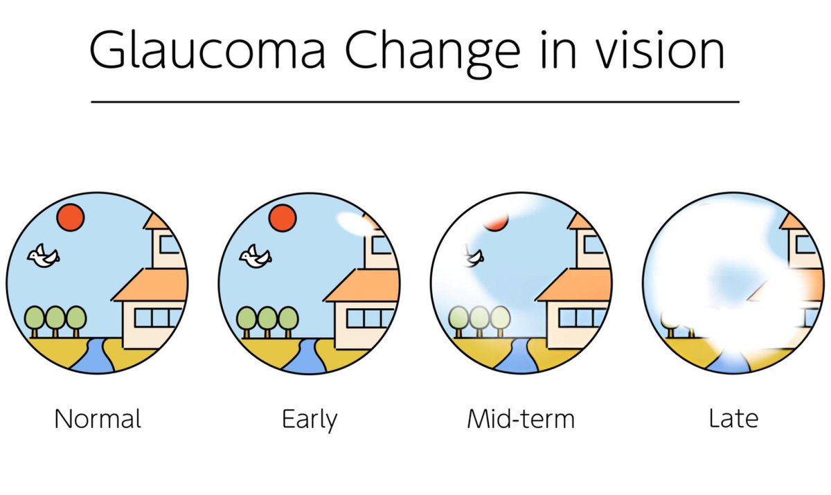 os_zim's tweet photo. Glaucoma is a leading cause of blindness worldwide, but early detection and treatment can help preserve vision. This week, The Ophthalmological Society of Zimbabwe encourages everyone to get regular eye exams to check for signs of glaucoma. https://t.co/Dvq3K7pnGO