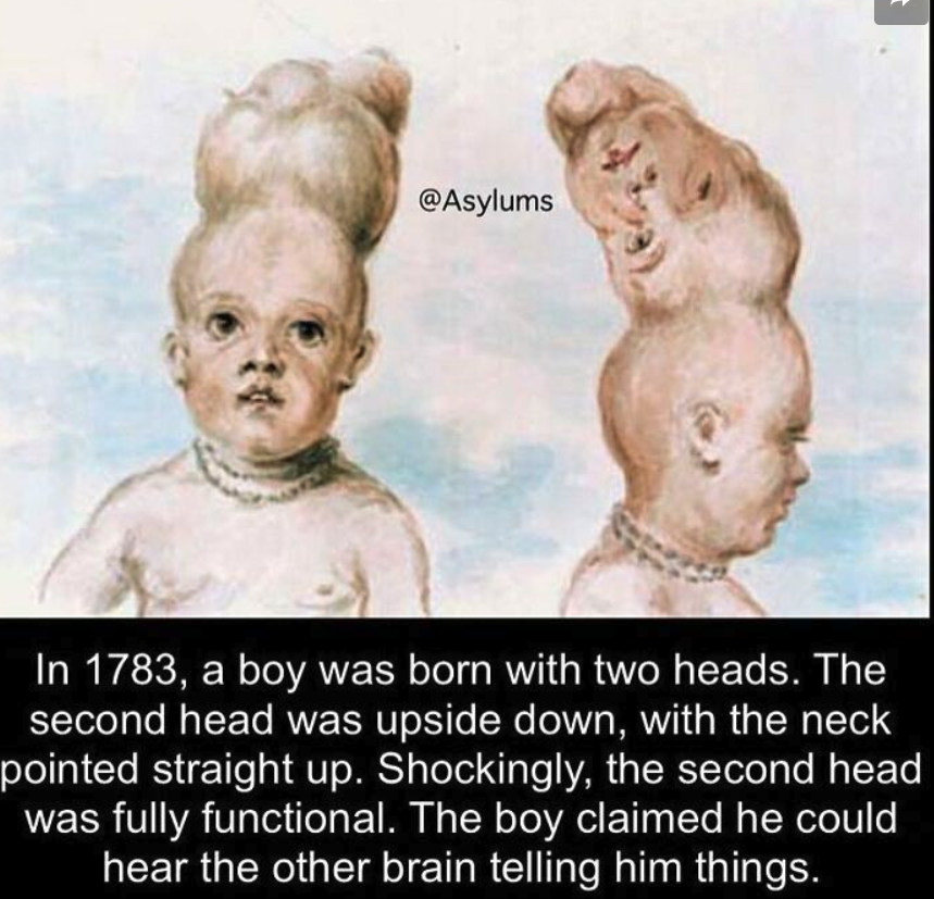 TCWTMedia's tweet image. 👶🧠 Terrifying Thursday Fact! 🧠👶

In 1783, a boy was born with two heads in Bengal, India! 😱 This rare condition, known as dicephalic parapagus, left the boy with two perfectly formed heads side by side on one body. 
#TerrifyingThursday #MedicalMysteries #TwoHeads