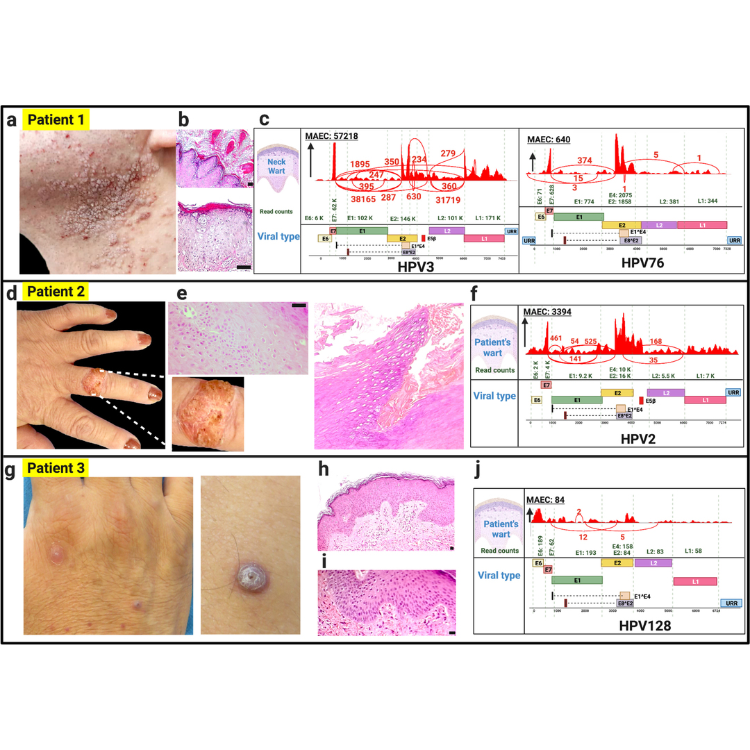 jidinnovations's tweet image. From the July issue: Novel whole #transcriptomesequencing as a new tool to identify viral infections in patients with #immunodeficiencies ow.ly/LMw150RlkBq #dermtwitter #medderm