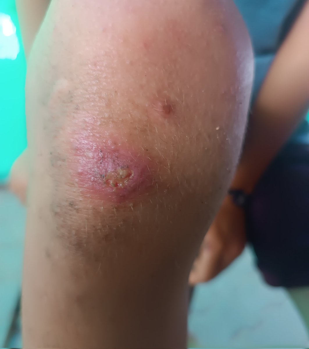 lipasillusion's tweet photo. ‼️🚨URGENT🚨‼️

NAMIR  CHILDREN ARE SICK WITH BACTERIA INFECTIONS due to the polluted water and air. 

please, if you are able, sh@re &amp; don@te ❤️
(something as simple as quoting &amp; retweeting has the potential to save lives) 

https://t.co/8bj0A1MyqD

@Luis95689377 https://t.co/h42PEpvSA3