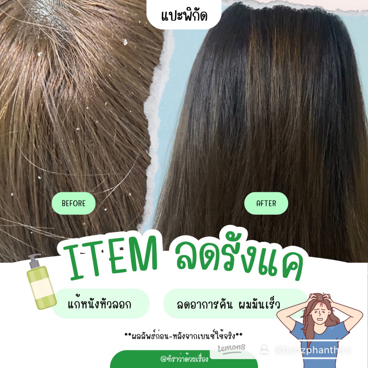 lleehKi's tweet photo. หมดปัญหารังแค หนังหัวลอกเรื่อรัง 🙅‍♀️ 
ใช้แชมพูอะไรก็ไม่หาย เบนซ์เคยใช้มาหลายตัวมาก แต่มาจบที่ตัวนี้ แพทย์แนะนำเลยนะ🧴แชมพูตัวนี้ตัวเดียวเอาอยู่ แพงหน่อย แต่มันดีย์ ✨ #แชมพู #รังแค #ขจัดรังแค #ยาสระผม 

พิกัด https://t.co/fYr1l6r4IZ https://t.co/Tgc3CdAOwD