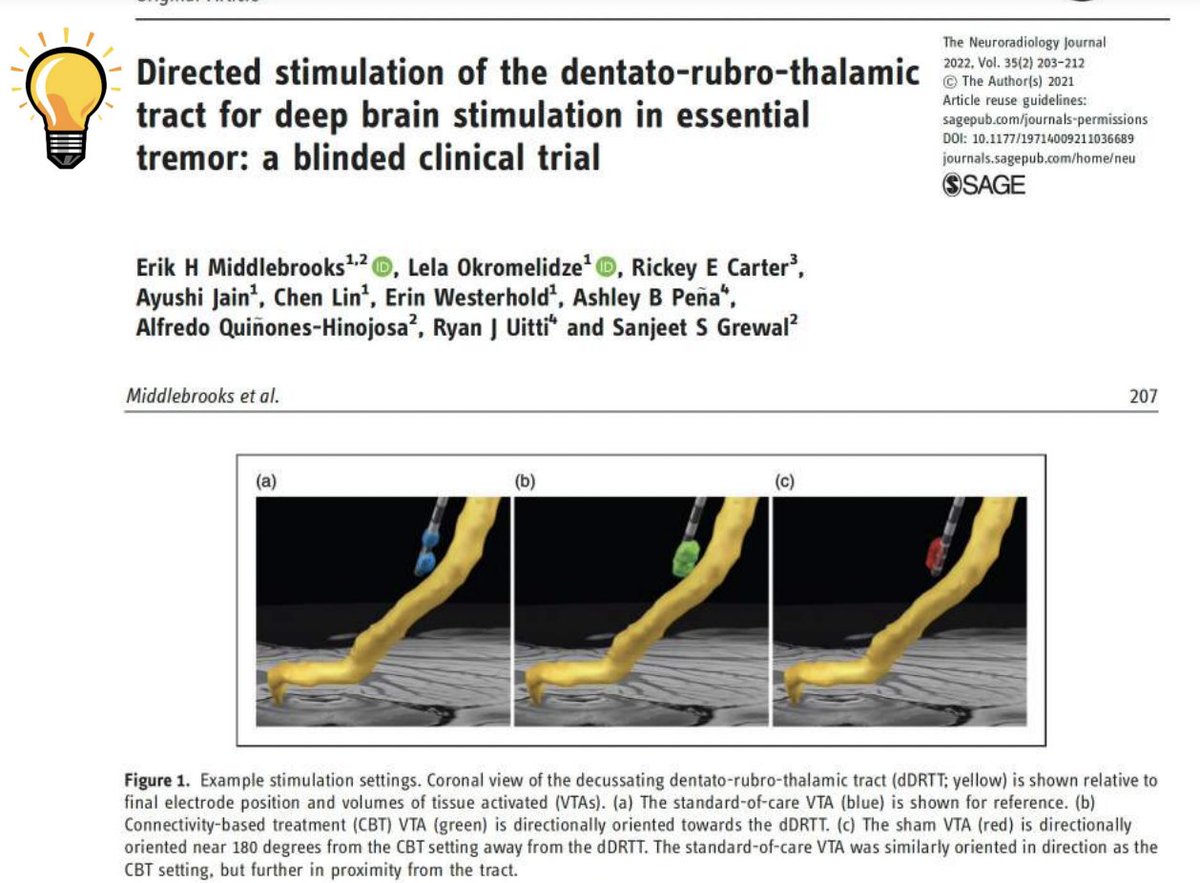 Michael Okun (@michaelokun) on Twitter photo The DBS field is changing, and soon we will be deliberating targeting the circuit, rather than pointing at a simple grey matter target. In fact, several folks have already shifted in this direction, such as in this recent paper by <a href="/EMiddlebrooksMD/">Erik Middlebrooks, MD</a> and colleagues. Nice discussion The DBS field is changing, and soon we will be deliberating targeting the circuit, rather than pointing at a simple grey matter target. In fact, several folks have already shifted in this direction, such as in this recent paper by <a href="/EMiddlebrooksMD/">Erik Middlebrooks, MD</a> and colleagues. Nice discussion