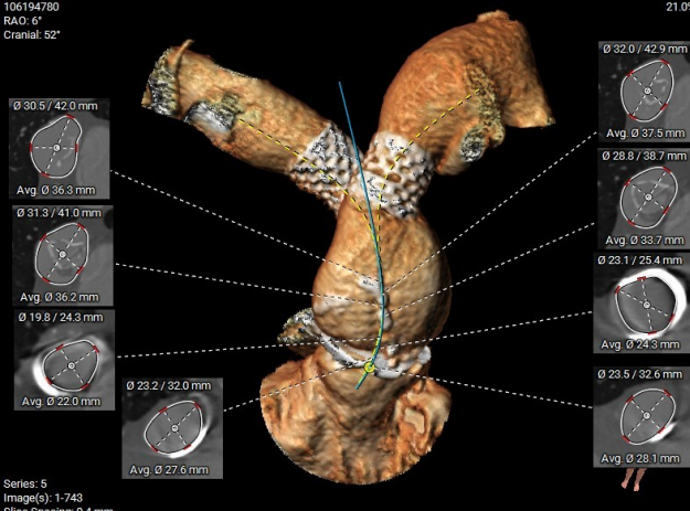 CraigBasman's tweet image. STRUCTURAL CASE OF THE WEEK;
35 M with TOF s/p repair at 13 months, b/l PA stents, severe PI s/p PVR (25mm Mitroflow) with symptomatic/severe bioprosthetic PR/PS.

Safest/best lifetime management option?
Redo surgery 
TPVR (23mm vs 26mm with BVF)
#tavr
#achd