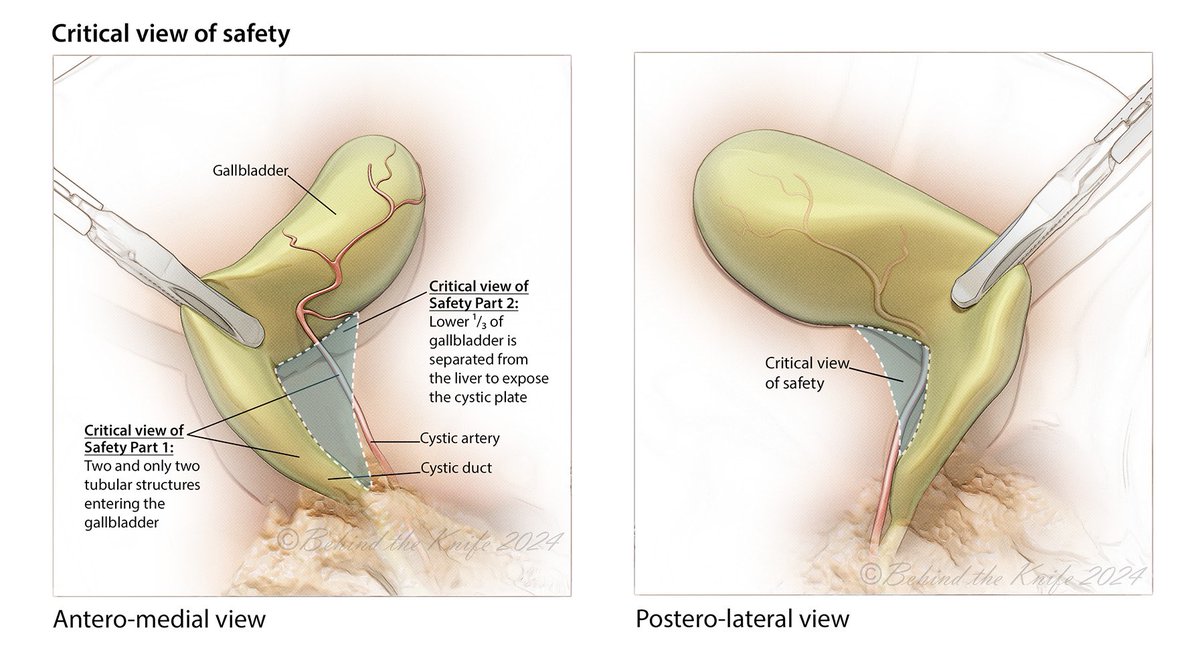 Visión de seguridad Colecistectomia 👇

Antero-Medial y Postero-Lateral.