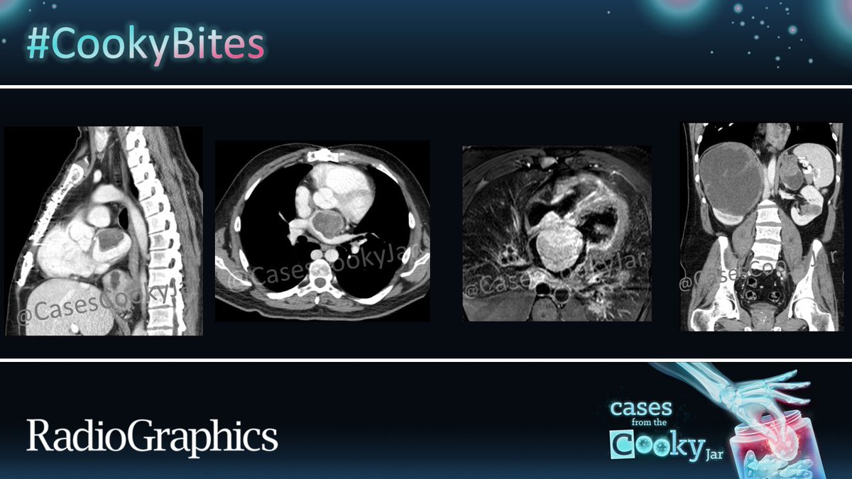 Cases From the Cooky Jar (@casescookyjar) on Twitter photo A 39-year-old 👨presenting with dyspnea🫁😮💨.
What is the diagnosis❓
We’ll post the answer in 24h. Share companion cases with us using #CookyBites #175. We will RT the best cases!
#RGphx <a href="/cookyscan1/">Cooky Menias</a> <a href="/RadioGraphics/">RadioGraphics</a> A 39-year-old 👨presenting with dyspnea🫁😮💨.
What is the diagnosis❓
We’ll post the answer in 24h. Share companion cases with us using #CookyBites #175. We will RT the best cases!
#RGphx <a href="/cookyscan1/">Cooky Menias</a> <a href="/RadioGraphics/">RadioGraphics</a>