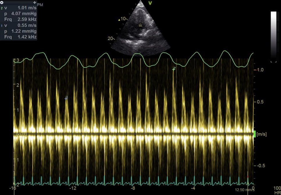 Ritika Tuli (@ritikatulimd) on Twitter photo 🫀During inspiration, the RV fills more, and due to ventricular interdependence, the LV fills less. In which condition(s) is this observed, and what is the typical clinical examination finding associated with this physiology? #CardioTwitter
<a href="/ACCinTouch/">American College of Cardiology</a> 🫀During inspiration, the RV fills more, and due to ventricular interdependence, the LV fills less. In which condition(s) is this observed, and what is the typical clinical examination finding associated with this physiology? #CardioTwitter
<a href="/ACCinTouch/">American College of Cardiology</a>