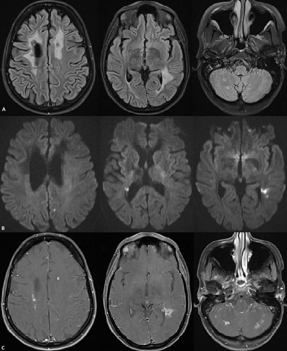 Brandon_Beaber's tweet photo. 39 year old woman with retinal vein occlusion with progressive left sided weakness.  Father and sister had a similar condition.  Liver enzymes elevated and liver biopsy with patchy inflammation/steatosis.  MRI brain showed THIS?  Immunosuppressants were ineffective.  Diagnosis? https://t.co/LBZ5E0ECKv