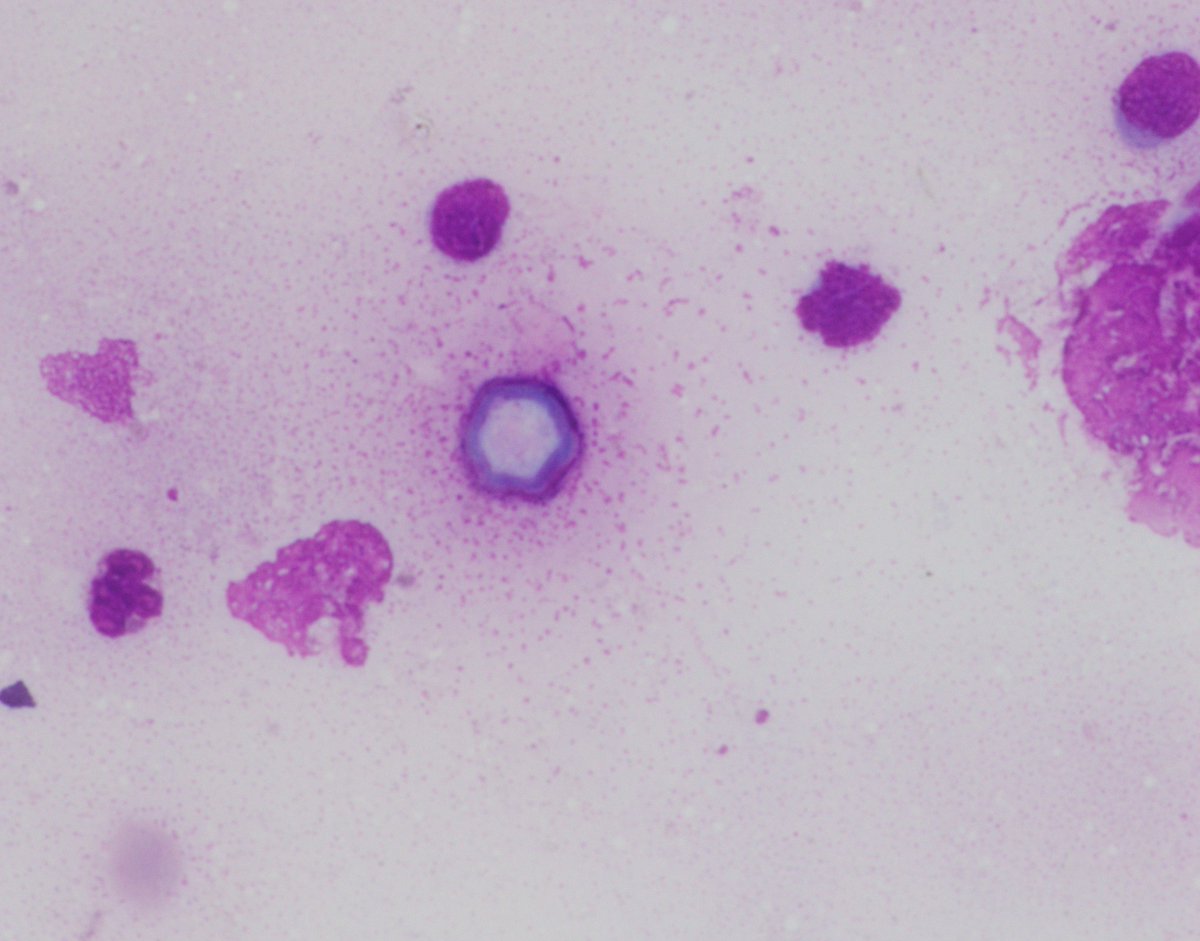 UpstateCytology's tweet photo. 18-year-old female presents with eye pain and blurred vision. She recently started to wear contact lenses. A corneal scraping is performed and shows the following. What is your diagnosis? https://t.co/9449UjBB5n
