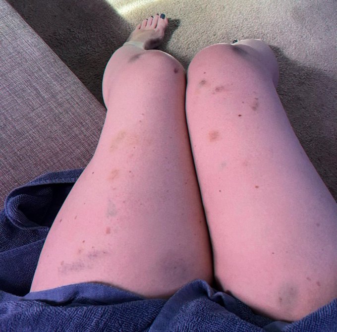this is what my legs look like after the move; look at all the purty colors 🥴more details on my IG if<a href="/tag/quoteoftheday"class="tags"><span>#quoteoftheday</span></a>