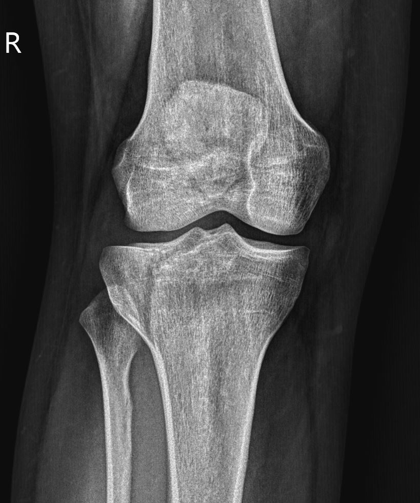 themskarchive's tweet photo. 2/8/2024. 🟥 Female, 20 yo. 🦵 How would you treat this?🧑🏫
#traumatwitter
#knee
#schatzkerclassification
#XRAY https://t.co/vwZS0lA6nz
