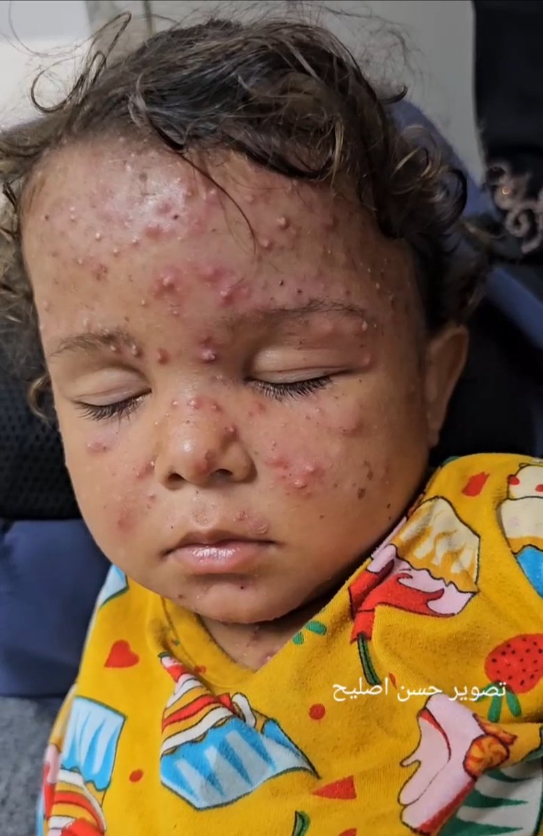 QudsNen's tweet photo. The young girl Nora Nidal Al-Shawaf is suffering from a viral infection affecting her face and head, causing severe sleep deprivation. This comes amid a surge in skin diseases among children in Gaza due to Israel's destruction of medical facilities and infrastructure. https://t.co/AkPGrfCzal