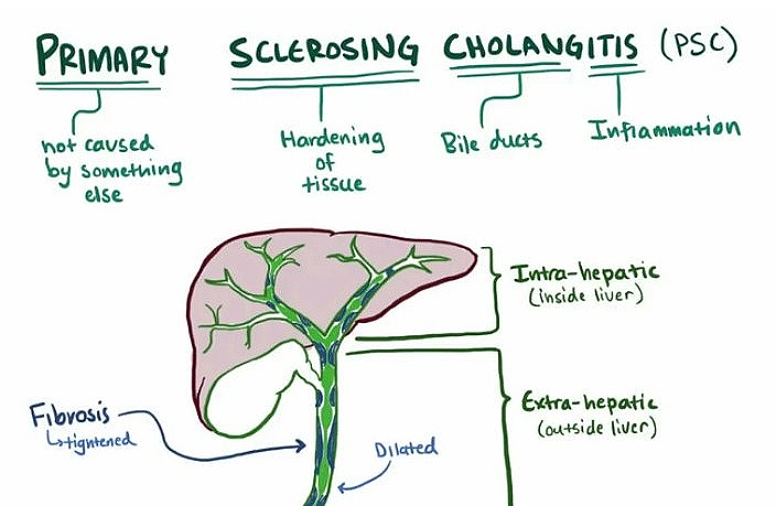 aaronjhill's tweet image. Primary #sclerosing #cholangitis, also called primary #biliary cholangitis, is such a pain. It is difficult to diagnose, and most #doctors do not have a clue. It is an #autoimmune disorder.