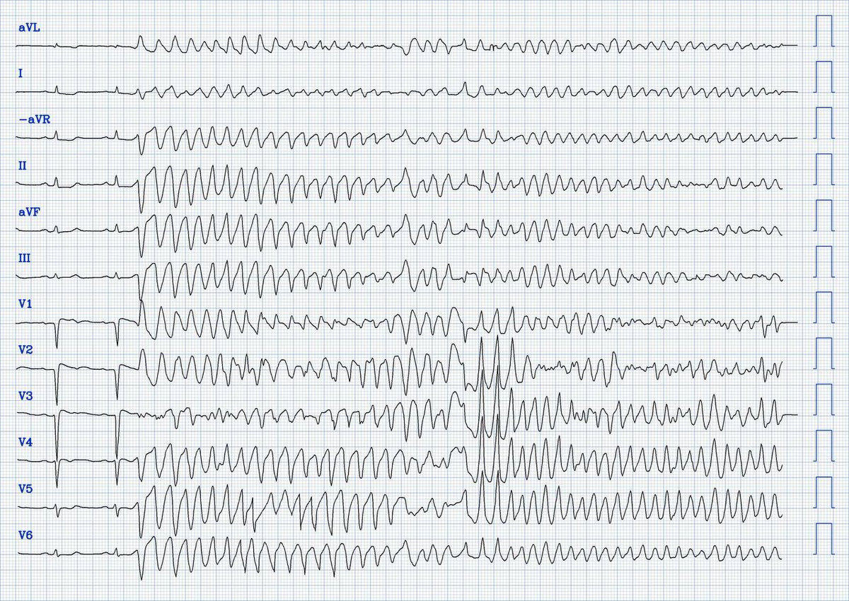 What are treatment options for this rhythm, when all else fails?

hqmeded-ecg.blogspot.com/2024/07/what-a…

ECG 1: prehospital
ECG 2: PMVT after PCI