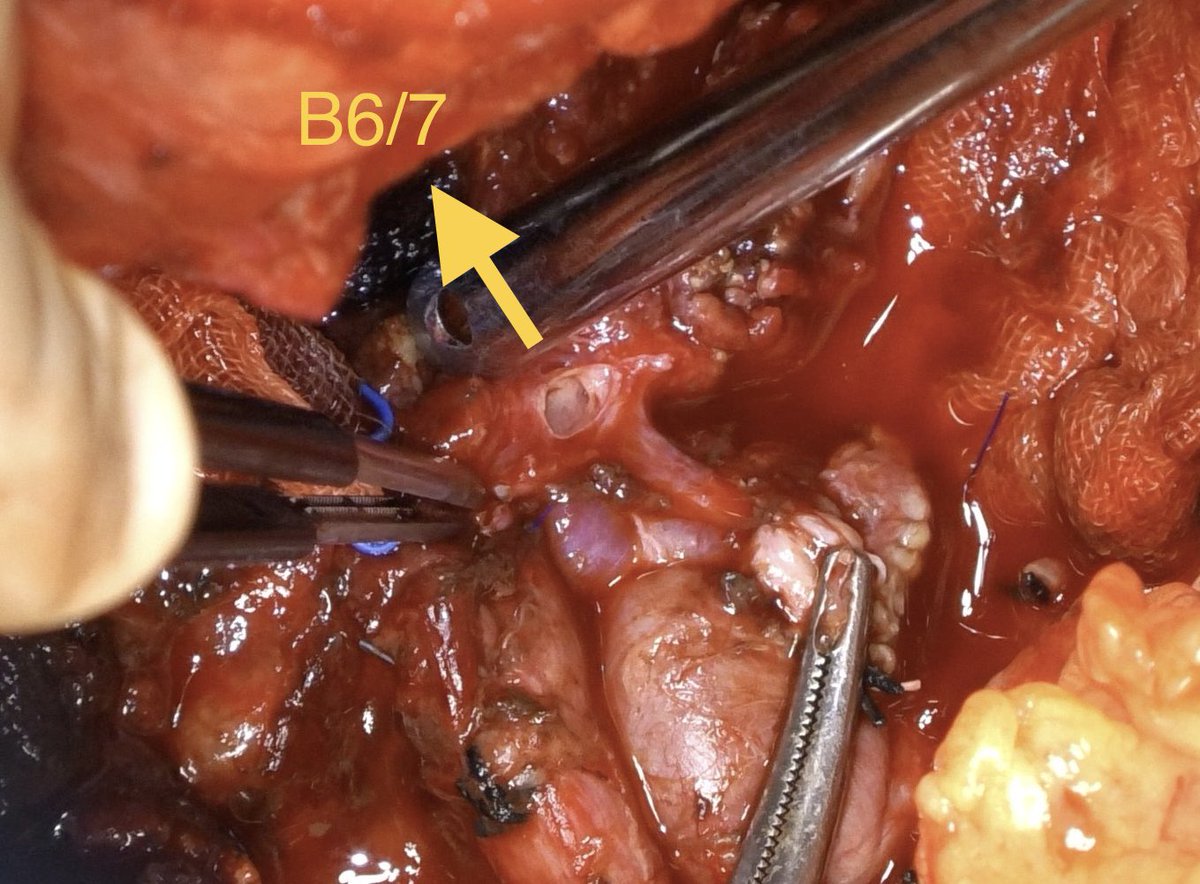 For me,left trisectionectomy with biliary reconstruction is the most difficult HBP operation.