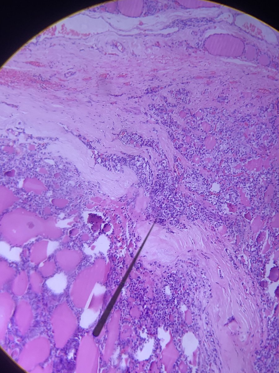 userrecon's tweet photo. Currently strugling with this case, would appreciate your opinioins.

F, 30 y.o., thyroid nodule 0.6 cm.

With a history of previous FNA, would you call this capsular invasion or not?

#PathTwitter #EndoPath #thyroidpath #endopath https://t.co/JrvY9LcBAY