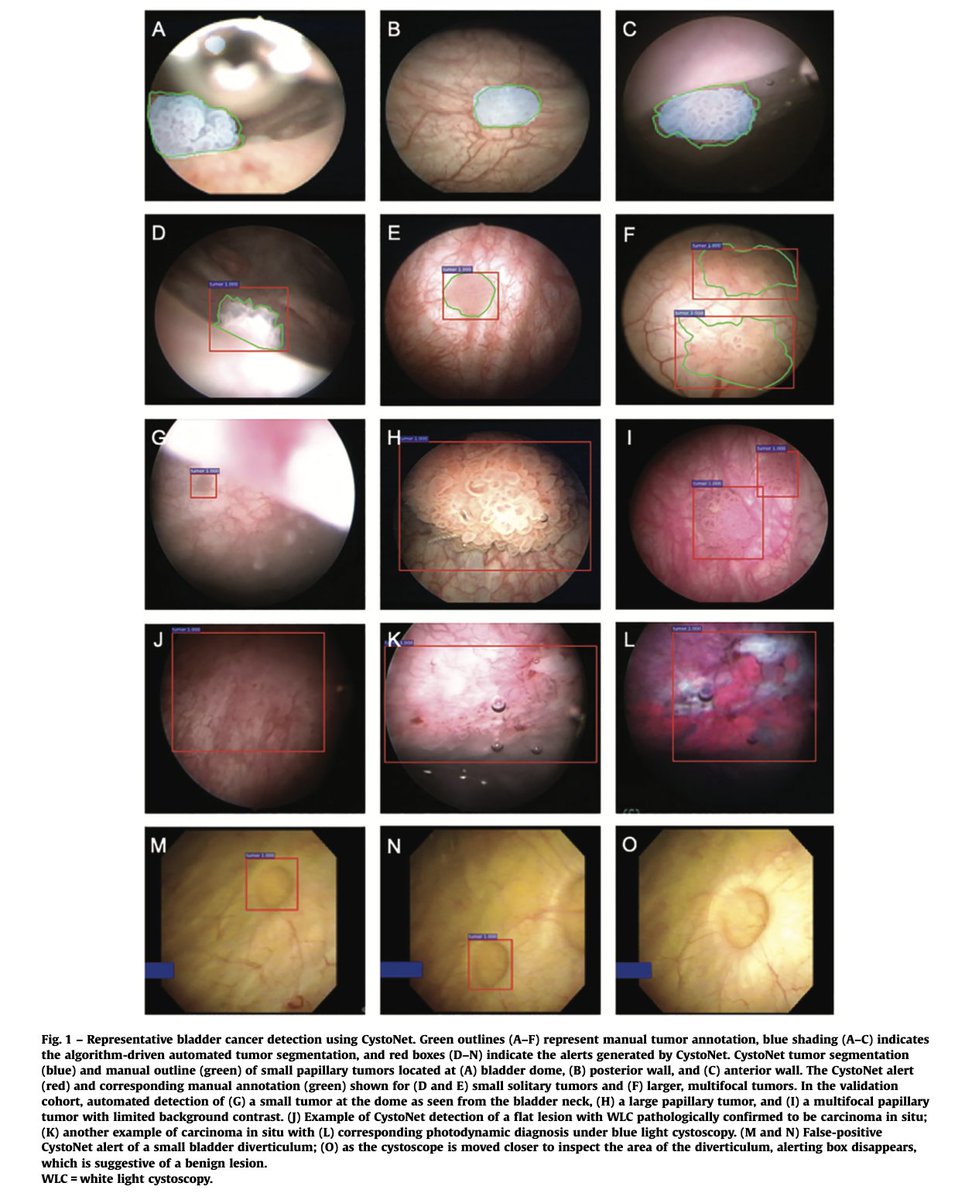 Prajwal2816794's tweet photo. #LSPPDay51
Got to know about Bladder Cancer detection using machine learning which uses the data of CT scans &amp; Cystoscopy which likely uses parameters like Wall thickness, Tumor size, &amp; Regularity loss.
Special Thanks to Dr. Pradip Subedi.
 #60DaysOfLearning #LearningWithLeapfrog https://t.co/V9bQTcMlOZ