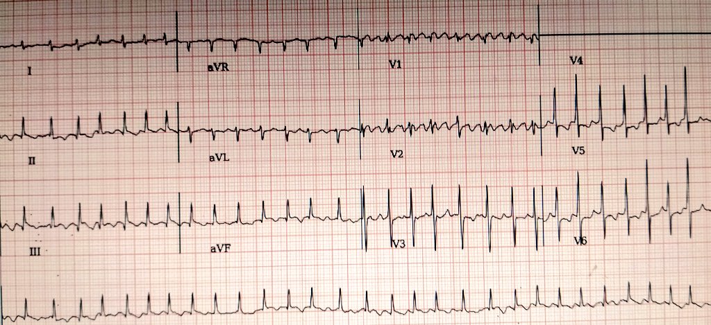 HarshitMis56211's tweet photo. ECG of a 50 year old male with several months of palpitations, dizziness and occasional chest pain. No syncope.
All labs normal
#Cardiology #CardioTwitter #Epeeps @Hapa_EP @melhamriti @ArashArya_EP @DrV_Mann @ugurcanpolatmd @rythmo_sfc @AGEP_DGK #onlyecg #Ecgweekly https://t.co/TM6zYKMilR