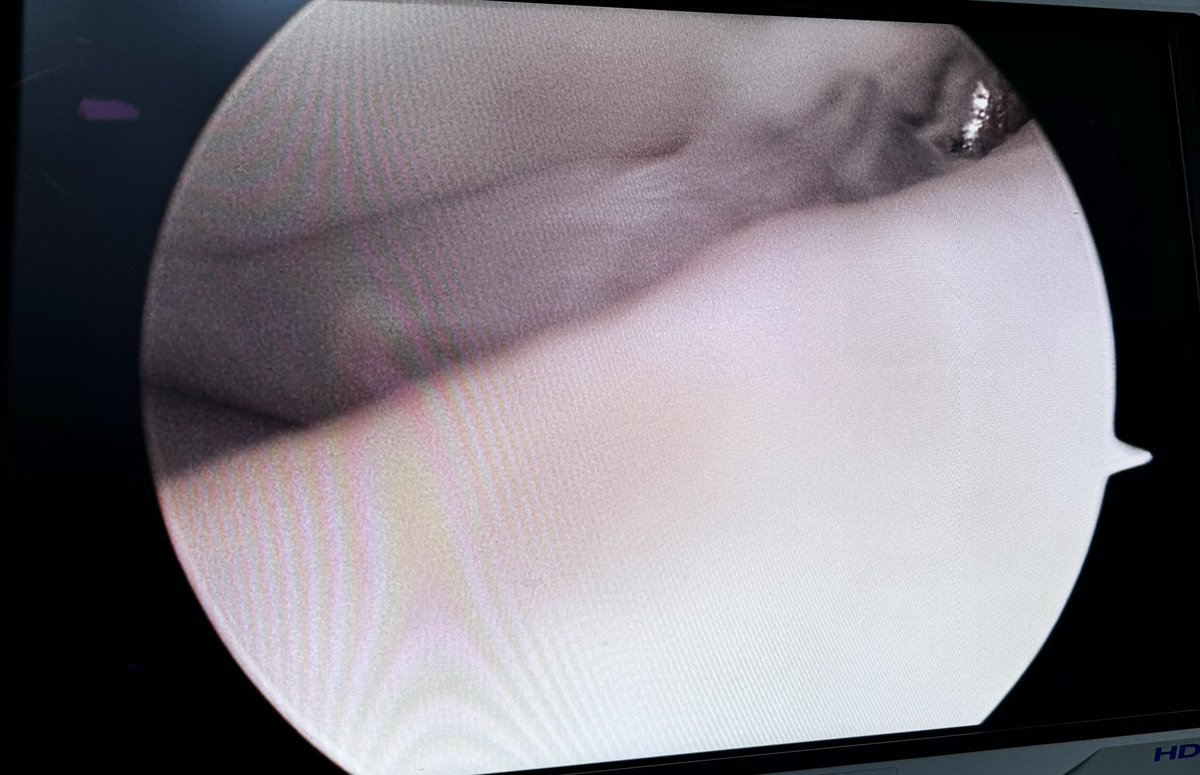 traumacenterec's tweet photo. Aqui podemos ver una imagen artroscópica de una lesion meniscal!!! https://t.co/j6TMRj4mba