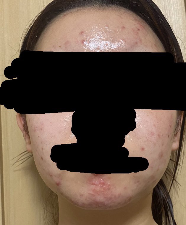 去年よりは全然マシだって思っても無理だよね
写真の方が綺麗に見えてるけど実際はもっと汚ったないです
 数時間でいつの間にか赤ニキビ誕生だもんどう対策しろと。