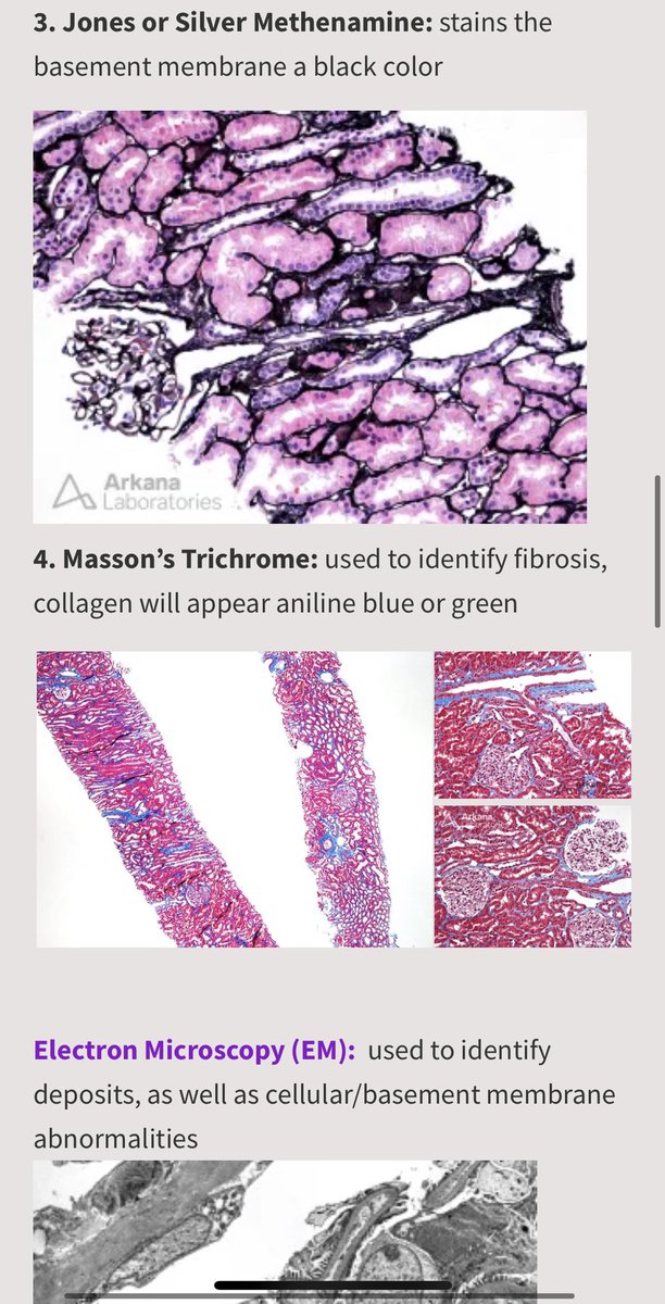 ssfarouk's tweet image. Pathology 101: An Approach to #KidneyPath @Neph_SIM

nephsim.com/pathology-appr… 

#BRCU2024