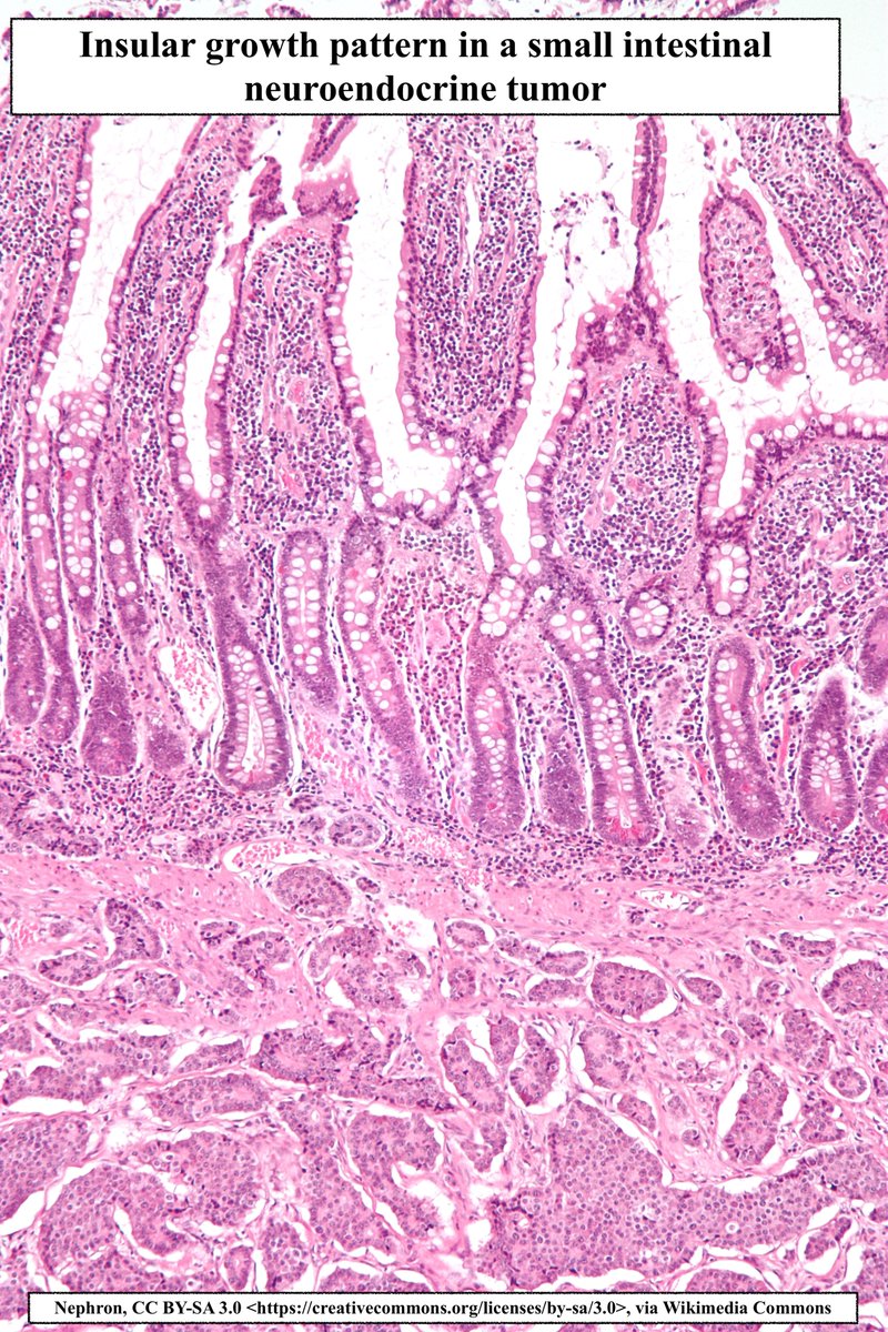 Path4People's tweet photo. Insular Architecture

•Growth pattern comprised of tightly packed islands or nests
•May be seen in Neuroendocrine tumors and  carcinomas, Poorly differentiated+medullary thyroid carcinoma
• Not to be confused w Zellballen pattern (has s100+ sustentacular cells)

#pathagonia https://t.co/dFADZ048yu