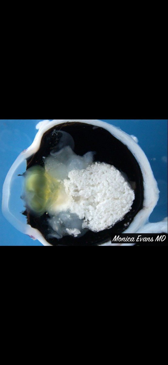 JMGardnerMD's tweet photo. Eye tumor from a baby. Entire globe of eye cut in half front to back. Amazing pics by Dr. Monica Evans. Your diagnosis? Reply then click the link to check your answer https://t.co/KB8IE1i8ma #pathologists #pathology #pathTwitter #ophthalmology #ophtho #eyepath https://t.co/f4pjfczqWm
