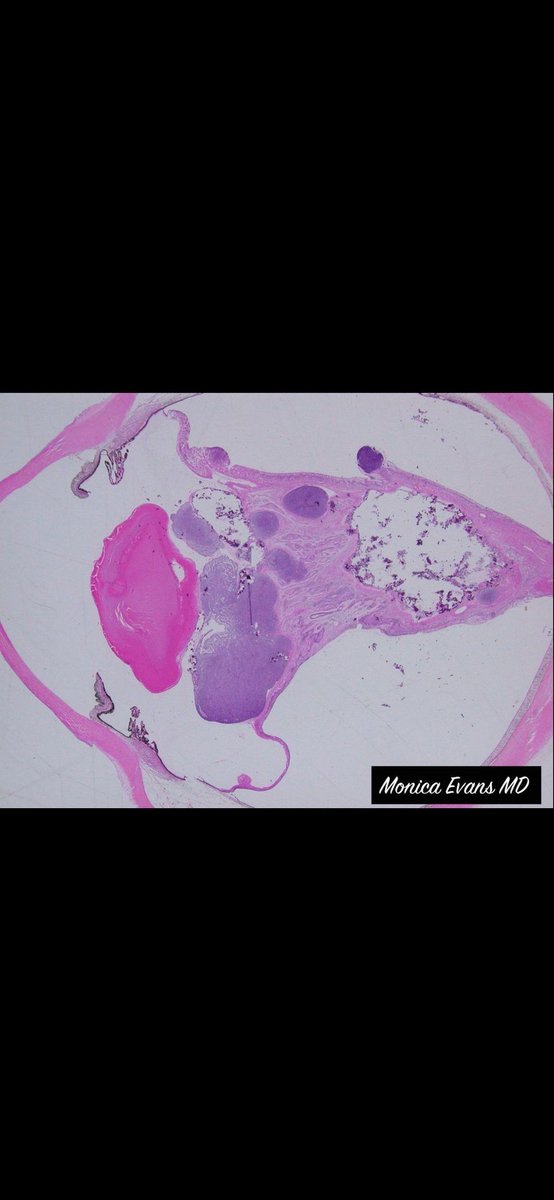 JMGardnerMD's tweet photo. Eye tumor from a baby. Entire globe of eye cut in half front to back. Amazing pics by Dr. Monica Evans. Your diagnosis? Reply then click the link to check your answer https://t.co/KB8IE1i8ma #pathologists #pathology #pathTwitter #ophthalmology #ophtho #eyepath https://t.co/f4pjfczqWm