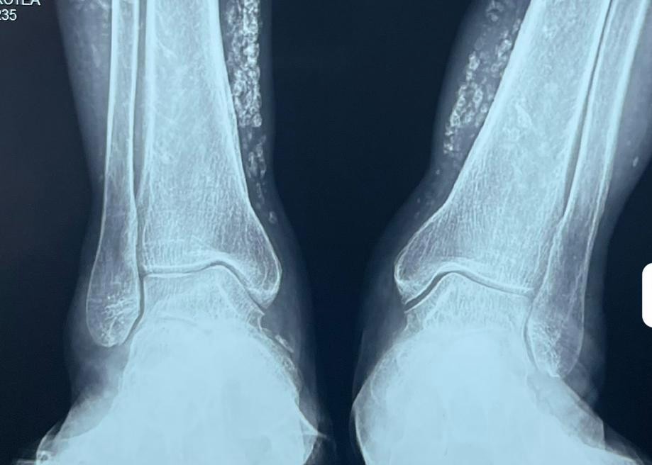 ConsejosReumato's tweet photo. Calcinosis en piernas de paciente con #dermatomiositis . #miositis #myositis #muscle #CPK #calcinosis #legs https://t.co/UGEqJfWQDB