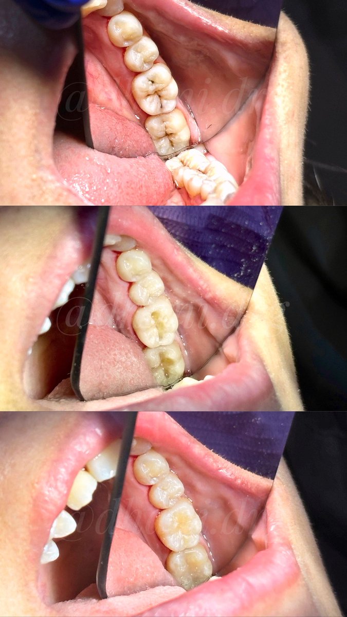 dailydoseofmood's tweet image. makin kesini pasien-pasienku pada aware sama gigi berlubang tanpa nunggu muncul keluhan yaa. jadi seneng!

rutin cek gigi 6 bulan sekali yaa! jangan tunggu gigi sakit baru datang ke dokter gigi yaa 🥹🤗❤️

#directcomposite