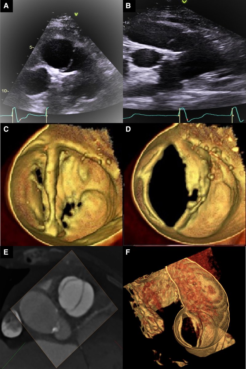Unexpected discovery of a bicuspid pulmonary valve on 3D transoesophageal echocardiography 
Hong S Lee et al. by #EHJCVI <a href="/denisamuraru/">Denisa Muraru</a>
☑️doi.org/10.1093/ehjci/…
<a href="/KemalogluOz/">Tuğba Kemaloğlu Öz, A/Prof</a> <a href="/alex1708ander/">Alexander Mladenow MD</a> <a href="/alexsfelixecho/">Alex Felix</a> <a href="/iamritu/">Ritu Thamman MD</a> <a href="/JGrapsa/">Julia Grapsa</a> <a href="/VDelgadoGarcia/">Victoria Delgado</a> <a href="/lpbadano/">Luigi</a> <a href="/fiore_corrado/">Corrado Fiore</a> @FGraziani_