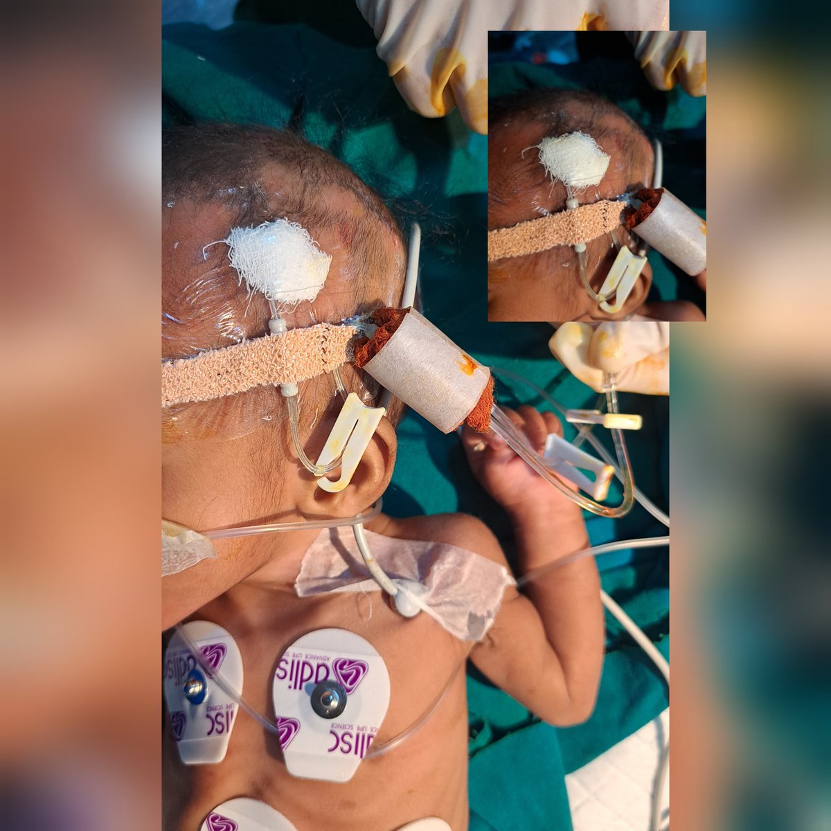 arunkrishnan_b's tweet photo. PICC line in superficial temporal vein https://t.co/JGsjwETCaP