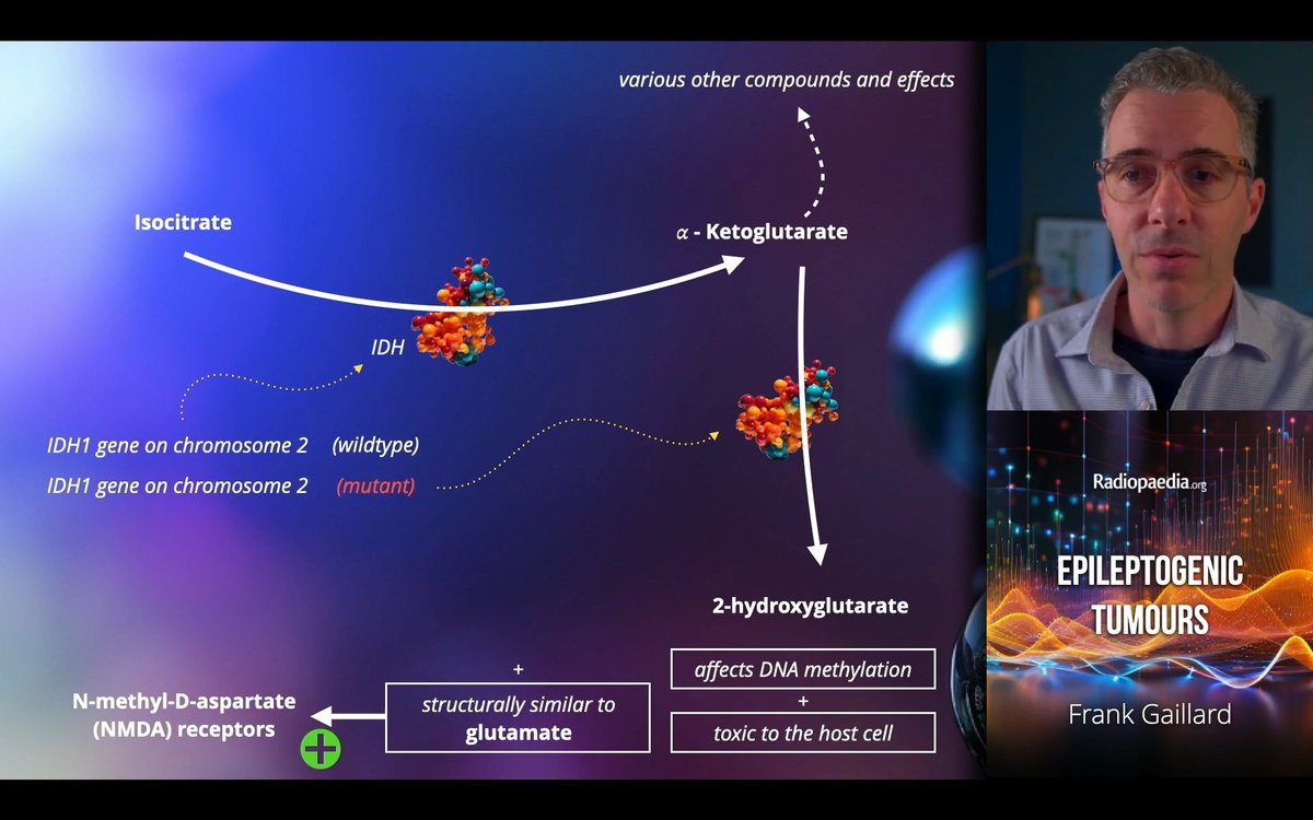 Rohit Sharma (@piandro3142) on Twitter photo Love this tangential pearl from <a href="/frankgaillard/">Frank Gaillard</a>, day 1 #Radiopaedia2024, explaining why tumours cause seizures. In particular, that IDH1/2 mutant tumours (e.g. low-grade gliomas) produce D-2-hydroxyglutarate, which is structurally similar to excitatory neurotransmitter glutamate! Love this tangential pearl from <a href="/frankgaillard/">Frank Gaillard</a>, day 1 #Radiopaedia2024, explaining why tumours cause seizures. In particular, that IDH1/2 mutant tumours (e.g. low-grade gliomas) produce D-2-hydroxyglutarate, which is structurally similar to excitatory neurotransmitter glutamate!